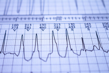 Close-up of heartbeat recorded on paper. Electrocardiogram with cardiac arrhythmia. Ventricular...