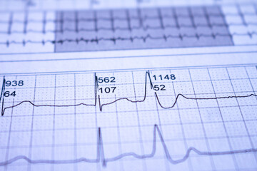 Close-up of heartbeat recorded on paper. Electrocardiogram with cardiac arrhythmia. Ventricular extrasystoles recorded