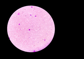 Microscopic image of Hereditary hemolytic anemia with copy space. Hemoglobin E (HbE) disease is a...