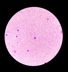 Hereditary hemolytic anemia. Hemoglobin E (HbE) disease is a mild, inherited blood disorder
