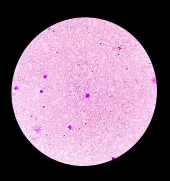 Hereditary hemolytic anemia. Hemoglobin E (HbE) disease is a mild, inherited blood disorder