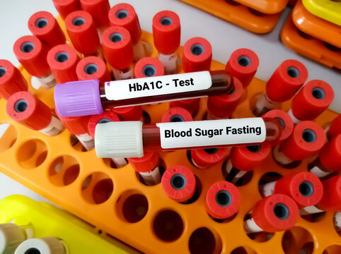 Blood samples for HbA1C and Blood sugar test, diagnosis monitoring of diabetes disease