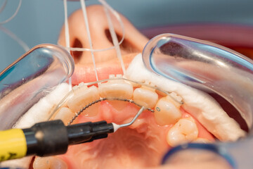 placing the fixed retainer in Process of removing dental braces from a Caucasian girl in a dental...