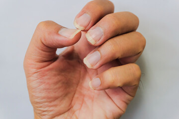 Dirty nails can cause serious contagious diseases, incomplete manicure for the background. Long...