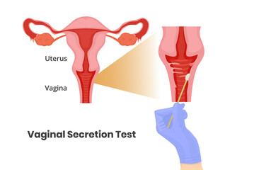 Vaginal secretion test. Vaginal swab vecor illustration.