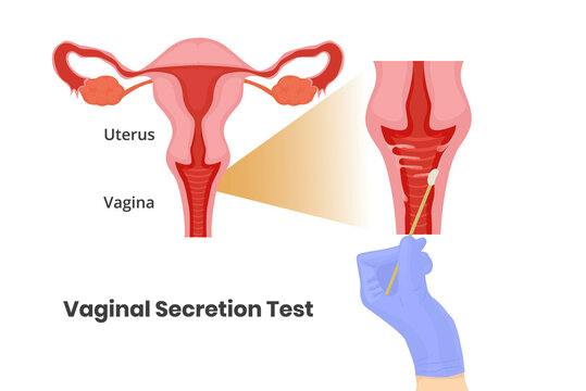 Vecteur Stock Vaginal secretion test. Vaginal swab vecor ...