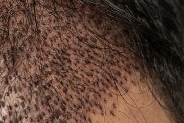 Close-up view of a man's head with hair transplant surgery. Bald head of hair loss treatment. An...