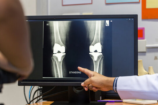 Doctor pointing on the knee problem point on x-ray film. x-ray film show skeleton knee on film. Surgery medical technology concept. Osteoarthritis in the elderly.