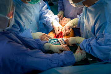 Shot of emergency and serious accident. Medical Team Performing Surgical Operation in Modern Operating Room. Medical team performing surgery in hospital. Group of surgeon at work in operation theater.
