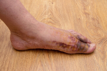 Swollen injured male limb on the left foot with hematoma when a heavy object falls on the leg