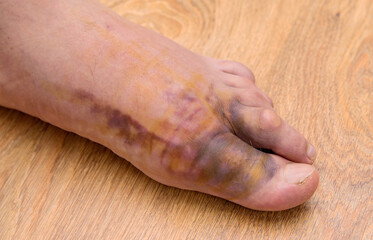 Swollen injured male limb on the left foot with hematoma when a heavy object falls on the leg