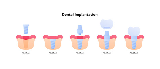 Tooth implant chart. Vector biomedical illustration. Cross section. Teeth prosthesis implantation steps isolated on white background. Design for dental oral healthcare, dentistry