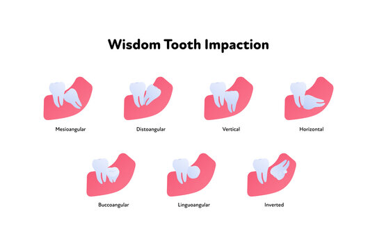 reverse impacted wisdom tooth