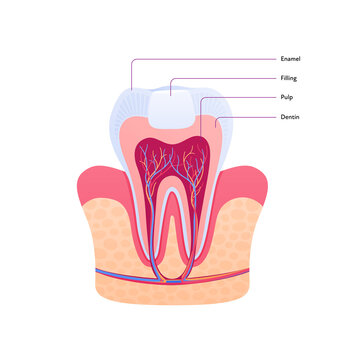 Filled tooth chart. Vector biomedical illustration. Cross section. Teeth with filling in gum isolated on white background. Design for dental oral healthcare, dentistry