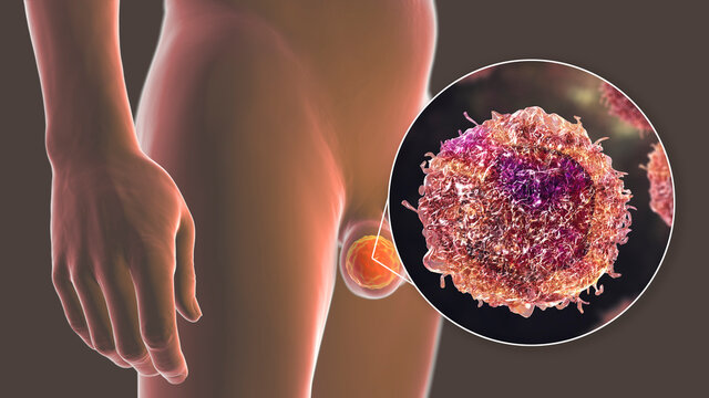 Testicular cancer, medical 3D illustration