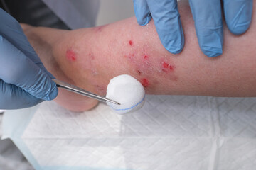 close-up of human shin, doctor treats numerous wounds on leg of an adult female patient, redness, scarring, sores from scratching, concept of medical care, self-harm to skin