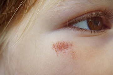 Portrait girl with an abrasion under her eye. child abuse. wounds and abrasions
