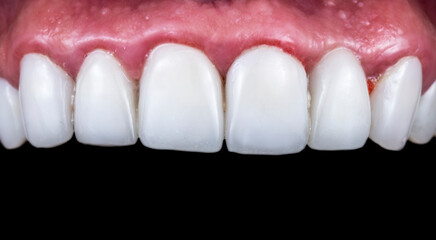 press ceramic crowns and veneers