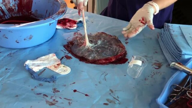 Nurse demonstrating real human placenta after baby delivery