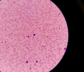 Microscopic image of Immune-hemolytic anemia, It's  immune system attack and destroy red blood...