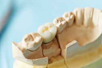 Image of denture close up