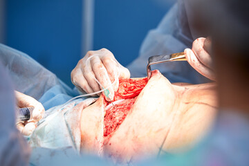 The doctor performs an operation to reconstruct the female breast. Close-up of plastic surgeon...