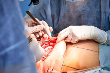 The doctor performs an operation to reconstruct the female breast. Close-up of plastic surgeon...
