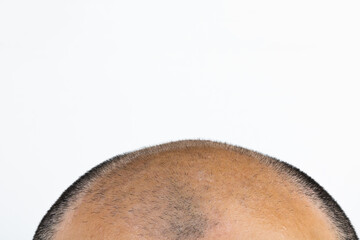 Mature man's head with thin hair. Hair loss or transplant background. Going bald