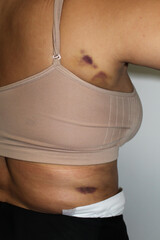 Woman's side showing brusing under and around her underarm or armpit due to cosmetic procedure, liposuction and also bruises shown on her side and hip area where a tummy tuck revision was performed - obrazy, fototapety, plakaty