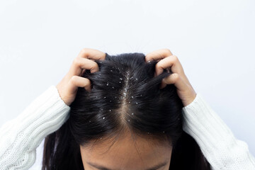Dandruff problem. A girl with itchy head. Dandruff on the hair. Hair disease seborrhea. Fatty Dandruff. - obrazy, fototapety, plakaty