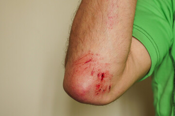 Fresh bleeding wound caused by falling on a hard rocks in a mountain