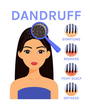 Dandruff on Hair. Scalp Disease and Beautiful Woman. Magnifying Blass and Close up view of Dandruff. Icons of Symptoms: Dryness, Redness, Itchiness. Image in Cartoon style. White background. Vector