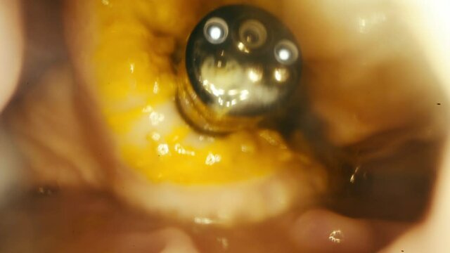 Stopping bleeding with a Clip applicator.