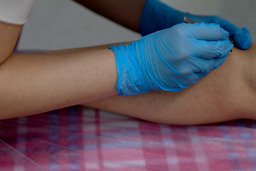 Epilation on the legs.Removal of unwanted hair on the legs.The master in disposable gloves removes the hairs with tweezers.Redness and irritation on the skin after depilation