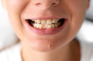 Crooked and yellow teeth. Woman has malocclusion. Adult orthodontics problem and treatment....