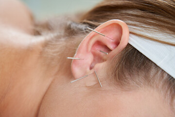 Beautiful woman relaxing on a bed having acupuncture treatment with needles in and around her ear....