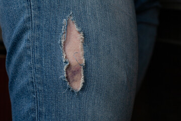 bruise visible through hole in jeans. selective focus.