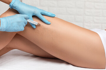 Removal of varicose veins on the legs. Medical inspection and treatment of Telangiectasia....