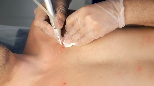 Surgeon removing moles and acne on man's chest using laser in hospital, hands in gloves closeup. Remove nevus on chest. One day surgery concept. Sore and wound after operation.