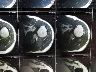 magnetic resonance imaging black white negative of the shoulder joint