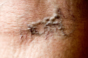 Varicose veins in the skin of the leg.