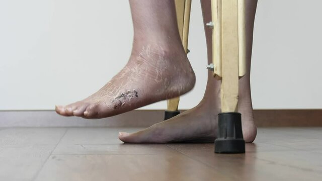 A woman after a broken leg to learn to walk. Rehabilitation after removal of plaster bandage. A woman walks on crutches.