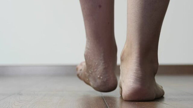 A woman after a broken leg to learn to walk. Rehabilitation after removal of plaster bandage. A woman walks on crutches.