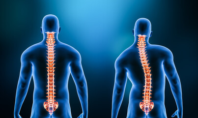 Comparison between normal backbone and scoliosis curvature of the spine with male model from back view 3D rendering illustration. Human anatomy, spinal deformity, backbone pathology, medical concepts.