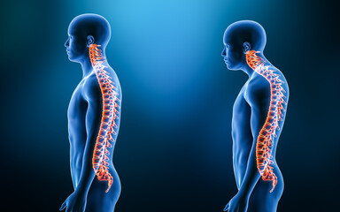 Comparison between normal curvature of the spine and kyphosis with male model from lateral view 3D rendering illustration. Human anatomy, spinal deformity, backbone pathology, medical concepts. - obrazy, fototapety, plakaty