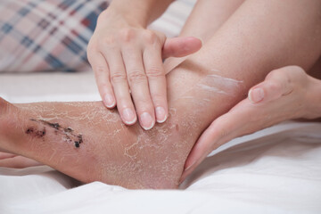 Applying the cream to the damaged skin of the leg. Rehabilitation after removal of plaster bandage