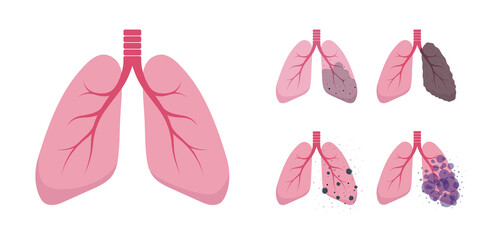 Set of lungs illustrations. Healthy and sick lungs. Human respiratory system icons