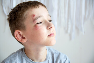 Portrait of a boy of 10 years with an abrasion on his face from a fall or fight.