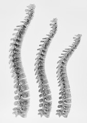 Osteoporosis curvature stages of the spine - 3D Rendering