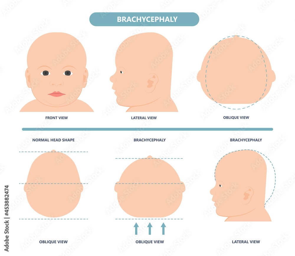 Wall mural craniosynostosis helmet pillow flat head autism brain skull bone deformity baby infant child newborn defect birth anterior Metopic Born genes genetic position sleep shape deformation tummy time 